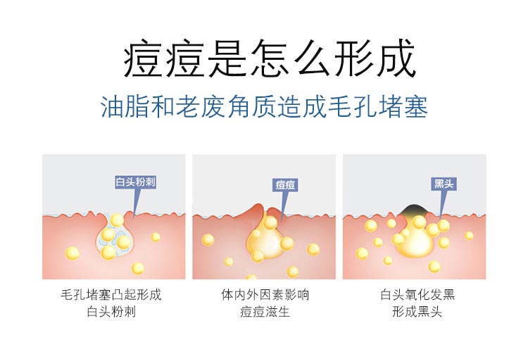 油脂和老废角质造成毛孔堵塞